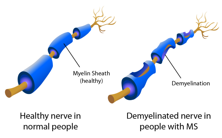 مروری جامع بر بیماری ام‌اس (MS) و سایر بیماری‌های خودایمنی